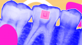 3. A tooth-mounted sensor that tracks food intake